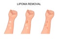 Lipoma. removal of lipoma on forearm