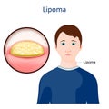 Lipoma. Skin disease Royalty Free Stock Photo
