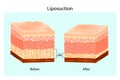 Liposuction. The Human Skin layer before lipo and after Liposuction.