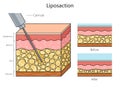 Liposuction diagram medical science