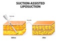 Liposuction