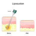 Liposuction procedure Royalty Free Stock Photo