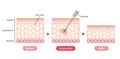 Liposuction process vector illustration / sectional view of skin Royalty Free Stock Photo