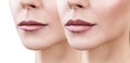 Lips of adult woman before and after augmentation