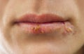 Lips affected by herpes