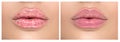 Lips. Close up of chapped, cracked lips, dry skin problem with mouth disease before and after treatment