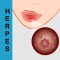 Lips closeup with cold herpes, sore on the lip