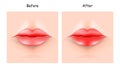 Lips Dry After Moistening. Protect Lips before and after