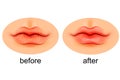Lips are dry and after moistening