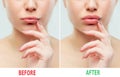 Before and after lips filler injections. Beauty plastic. Beautiful perfect lips with natural makeup. Royalty Free Stock Photo