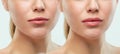 Before and after lips filler injections. Beauty plastic. Beautiful perfect lips with natural makeup. Royalty Free Stock Photo