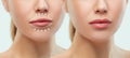 Before and after lips filler injections. Beauty plastic. Beautiful perfect lips with natural makeup. Royalty Free Stock Photo