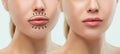 Before and after lips filler injections. Beauty plastic. Beautiful perfect lips with natural makeup. Royalty Free Stock Photo