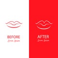 Lips reshaping before and after surgery. Royalty Free Stock Photo