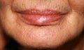 Lips. Silicone. Nasolabial folds. Wrinkles around the mouth