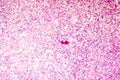 Liquefactive necrosis of the human brain, light photomicrograph