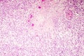 Liquefactive necrosis of the human brain, light photomicrograph