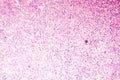 Liquefactive necrosis of the human brain, light photomicrograph