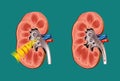 Lithotripsy in kidney stones