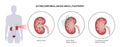 Lithotripsy procedure concept