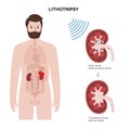 Lithotripsy procedure concept