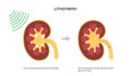 Lithotripsy procedure concept