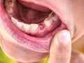 Little boy showing that he lost first milk canine tooth