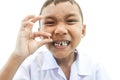 First broken a teeth. Royalty Free Stock Photo