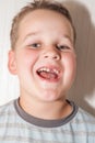 Little boy with a torn front first milk tooth Royalty Free Stock Photo