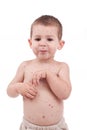 Little boy whit smallpox