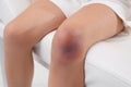 Little child with bruised knee sitting on examination table in hospital, closeup Royalty Free Stock Photo