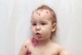 Little curly girl with brown eyes with chickenpox virus on a light background at home. Successful treatment of follicles with red Royalty Free Stock Photo