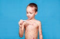 A little cute boy with a red rash on his body stands on a blue background and looks at the thermometer. The concept of chickenpox