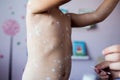 Little girl with chickenpox, antiseptic cream applied to the rash Royalty Free Stock Photo