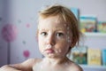Little girl with chickenpox, antiseptic cream applied to the rash