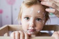 Little girl with chickenpox, antiseptic cream applied to rash Royalty Free Stock Photo