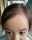 Little girl has allergies with mosquitoes bite and itching her skin. Mosquito blood breeding on kids.Repellent, Dengue virus, Royalty Free Stock Photo