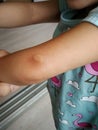 Little girl has allergies with mosquitoes bite and itching her skin. Mosquito blood breeding on kids.Repellent, Dengue virus, Royalty Free Stock Photo