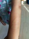 Little girl has allergies with mosquitoes bite and itching her skin. Mosquito blood breeding on kids.Repellent, Dengue virus, Royalty Free Stock Photo