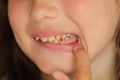 little girl opens her mouth and shows a sick tooth. caries on a baby tooth. Care for children's teeth. Damaged tooth