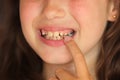 little girl opens her mouth and shows a sick tooth. caries on a baby tooth. Care for children's teeth. Damaged tooth