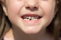 Little girl showing her front tooth missing