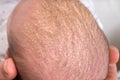 Newborn baby with psoriasis or dandruff in the hair Royalty Free Stock Photo