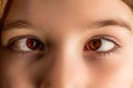 Little patient strabismus, treatment ophthalmic diseases. Strabismus in children causes, treatment concept. Female