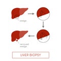 Liver biopsy