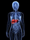 Liver cancer