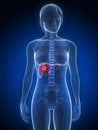 Liver cancer