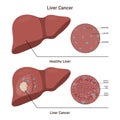 Liver cancer. Comparison between healthy organ and liver with carcinoma