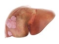 Liver cancer