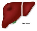 Liver cancer